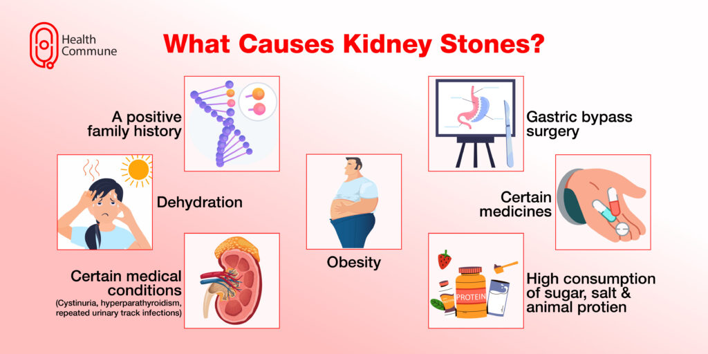 Kidney Stone