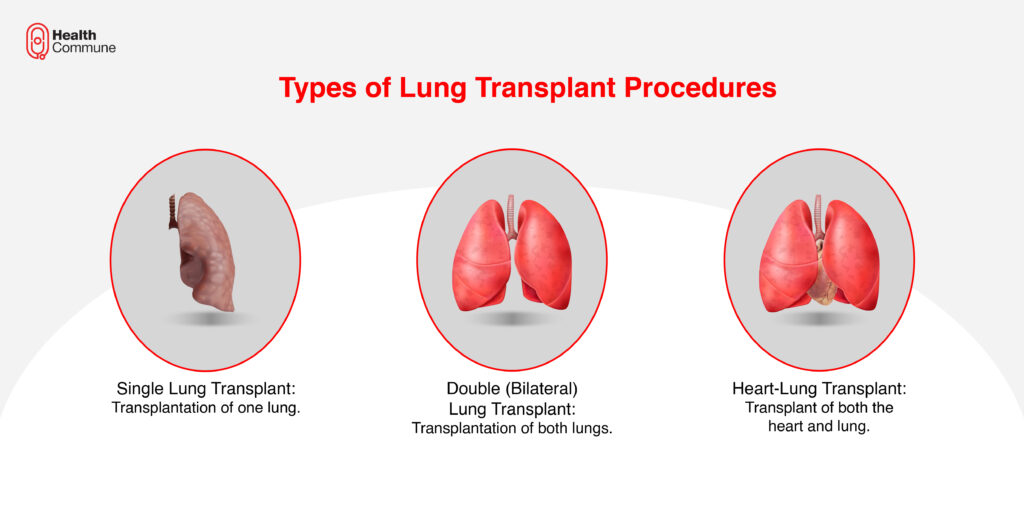 Types of Lung Transplant Procedures