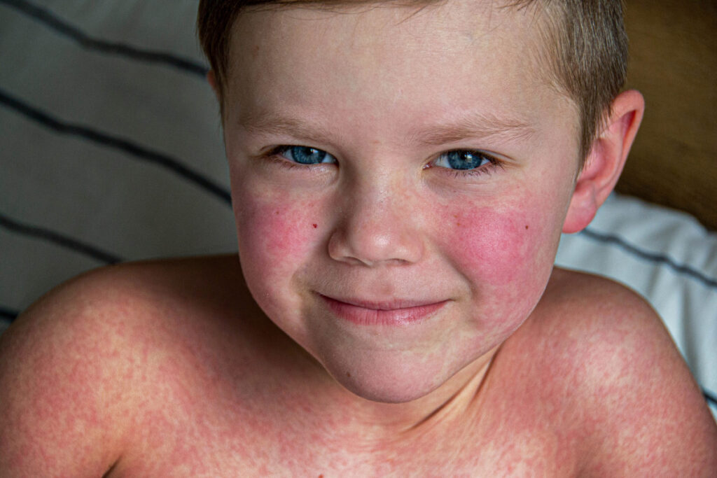viral disease measles rash body child allergy scaled ()